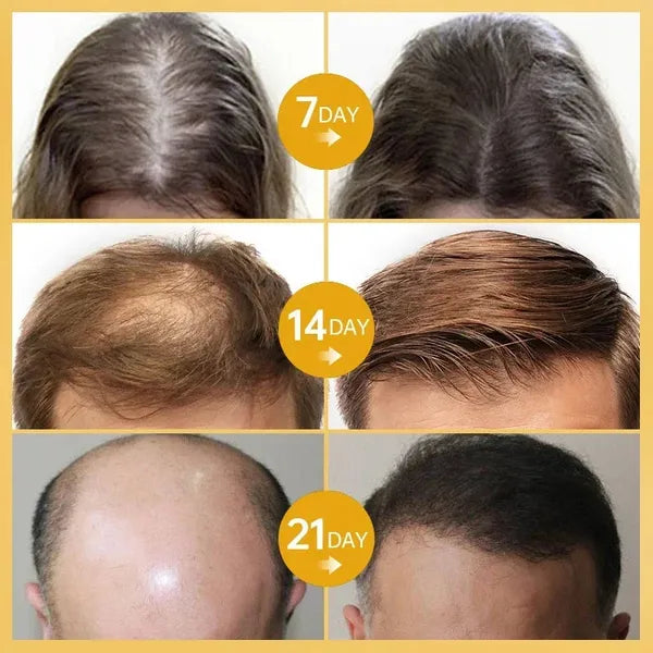 LOVILDS™ Rosemary Hair Growth Essence 100% Natural Hair Growth🌱
