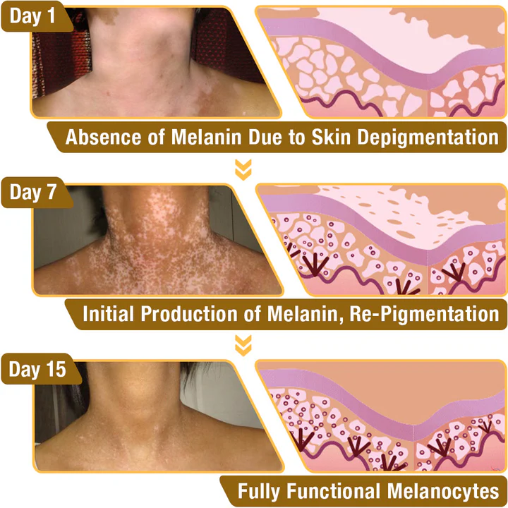 LOVILDS™ Bee Poison Vitiligo Treatment Cream