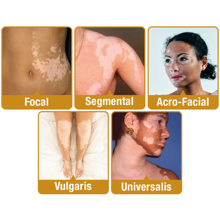 LOVILDS™ Bee Poison Vitiligo Treatment Cream