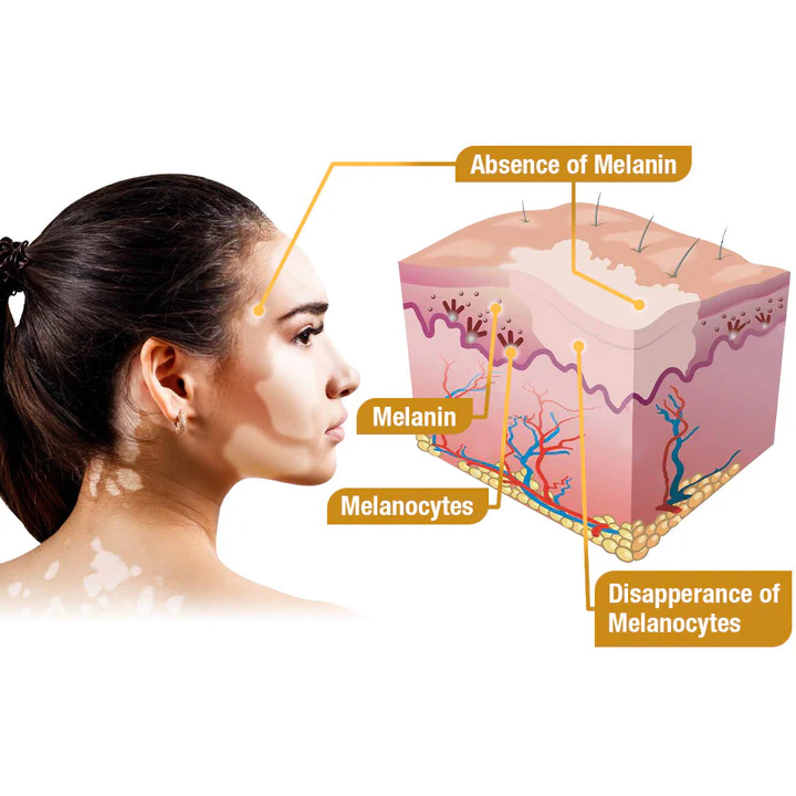 LOVILDS™ Bee Poison Vitiligo Treatment Cream